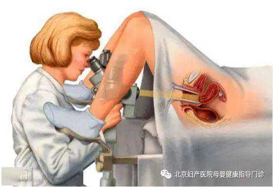 【妇产科普】妇科窥镜检查知多少